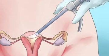 Когда можно планировать беременность после удаления кисты шейки матки