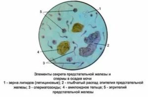 Забор секрета предстательной железы отзывы