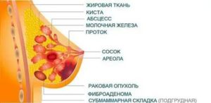 Сахарный диабет при операции рака молочных желез