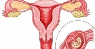 Могут ли быть скудные месячные из за тонкого эндометрия