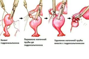Можно ли вылечить гидросальпинкс без операции после 45
