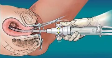 Почему нет месячных два месяца после выскабливания