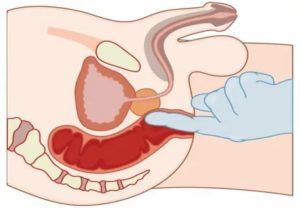 Пальпация простаты техника выполнения