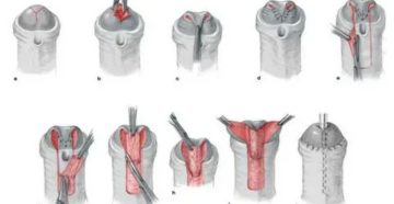 Что делать чтобы не было свищей после операции по гипоспадии