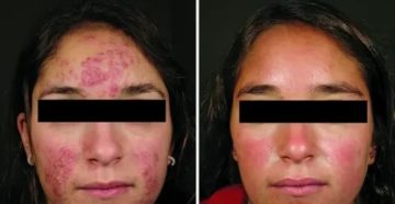 Как избавиться от прыщей после месячных