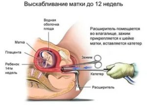 Почему нет месячных после выскабливания замершей беременности