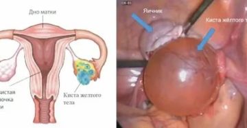Что значит киста яичника у новорожденного