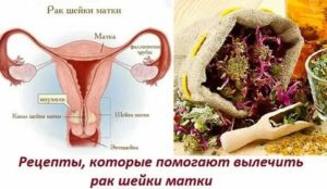 Как использовать чистотел при раке шейки матки