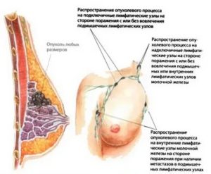 Что значит поражен один лимфоузел при раке молочной железы