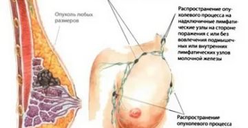 Что значит поражен один лимфоузел при раке молочной железы