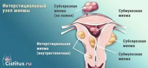 Интерстициальный узел по задней стенке матки при климаксе