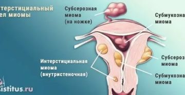 Интерстициальный узел по задней стенке матки при климаксе