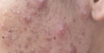 Могут от простатита появиться прыщи