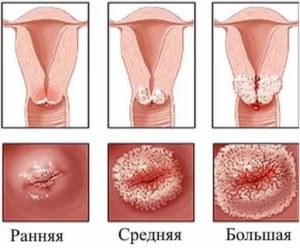 Диагностика эрозии шейки матки девственниц