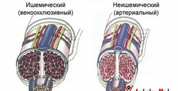 Как восстановить эрекцию после приапизма