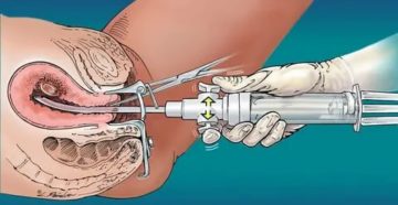 Антибиотики после выскабливания полости матки окситоцин