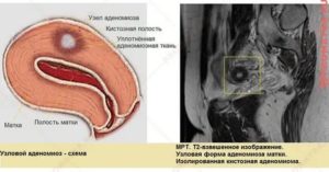 Внутренний эндометриоз диффузно-узловая форма что это такое