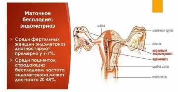 Что такое женское бесплодие маточного происхождения