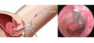 Сколько по времени делается гистероскопия эндометрия