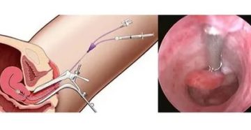 Сколько по времени делается гистероскопия эндометрия