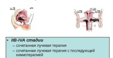 Что такое лазерная терапия при раке шейки матки