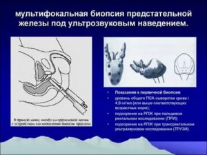 Полифокальная биопсия предстательной железы под трузи-контролем