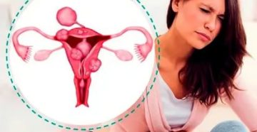 Почему болит живот при месячных при миоме матки Почему болит живот при месячных при миоме матки