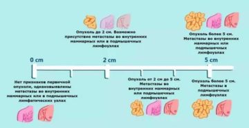 Как определить размер опухоли молочной железы