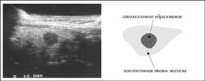 На узи гипоэхогенное образование молочной железы что это такое
