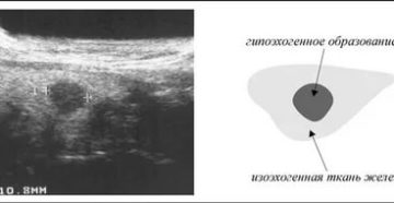 На узи гипоэхогенное образование молочной железы что это такое