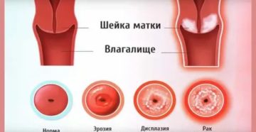 Фоновые заболевания шейки матки рак шейки матки