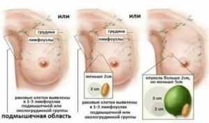 Как определить опухоль молочной железы на ощупь