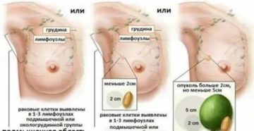 Как определить опухоль молочной железы на ощупь