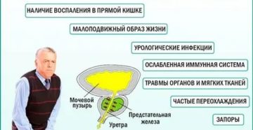 Обострение хронического простатита и лечение его в домашних условиях