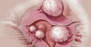 Чем отличается фиброма от кисты яичника