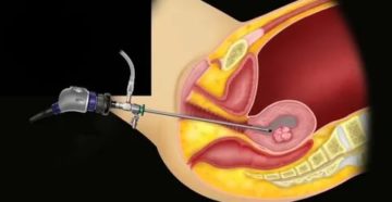 Что такое офисная гистероскопия с биопсией эндометрия
