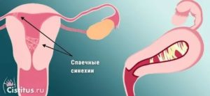 Как быть с синехиями в матке в постменопаузе