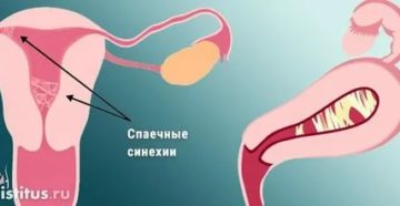 Как быть с синехиями в матке в постменопаузе