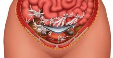 Почему болит живот как при месячных после кесарева сечения Почему болит живот как при месячных после кесарева сечения