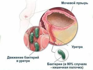 Может ли цистит или пиелонефрит передаваться половым путем