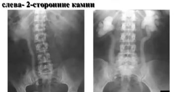 Можно ли делать экскреторную урографию во время месячных