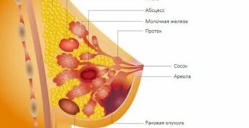 Эндометриоз и рак молочной железы лечение