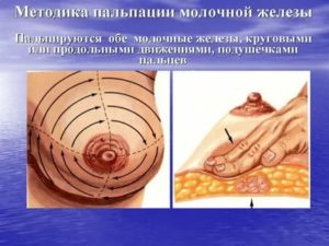 Пальпация молочных желез онкология