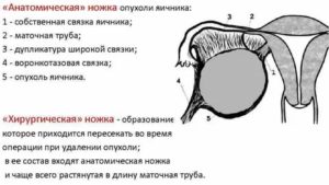 Хирургическая ножка опухоли яичника включает в себя