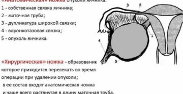 Хирургическая ножка опухоли яичника включает в себя