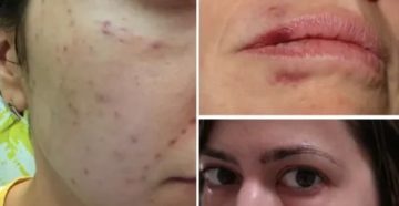 Почему нельзя делать уколы гиалуроновой кислоты во время месячных Почему нельзя делать уколы гиалуроновой кислоты во время месячных