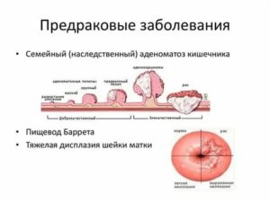 Что такое предраковая опухоль шейки матки