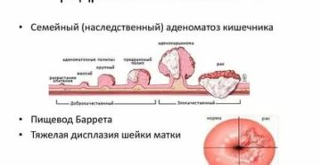 Что такое предраковая опухоль шейки матки