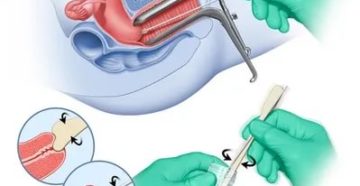 Почему нельзя брать мазок на цитологию во время месячных Почему нельзя брать мазок на цитологию во время месячных