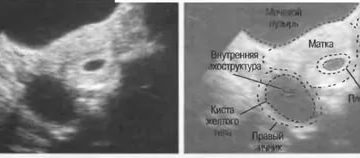 Узи признаки недостаточности желтого тела при беременности